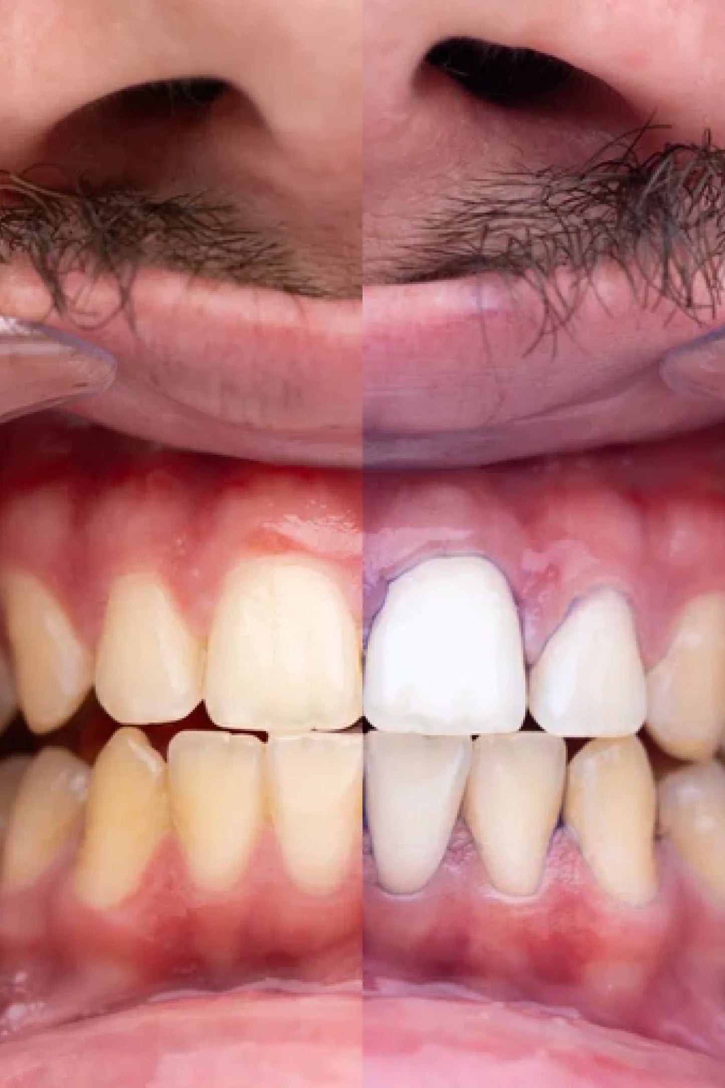 Espuma Blanqueadora Dental Morada